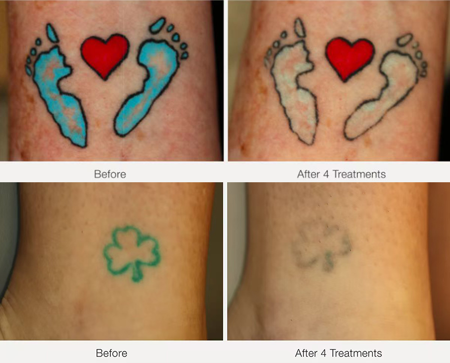 laser remove tattoo
