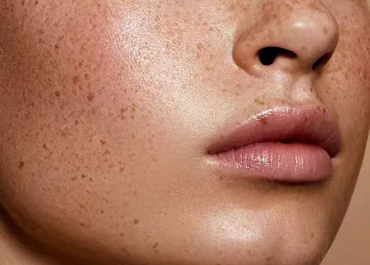 laser for hyperpigmentation